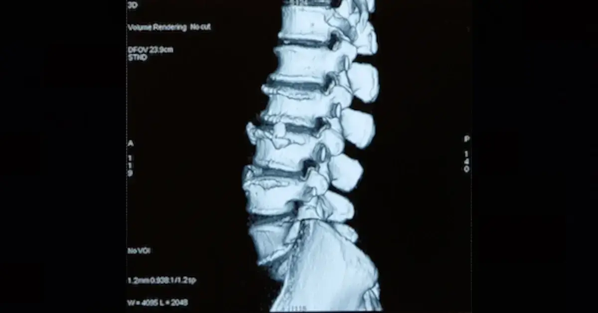 Spinal Arthritis.webp